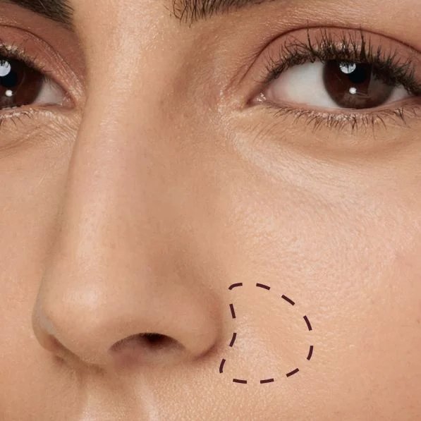 Area where redness might appear