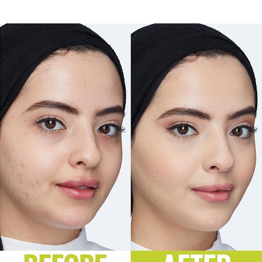Before and after image showing the effects of Maybelline’s Super Stay Concealer on a young woman’s face. After use, her skin is smoother and less blemished